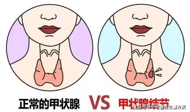 甲状腺结节健康科普（甲状腺结节的健康指导内容）