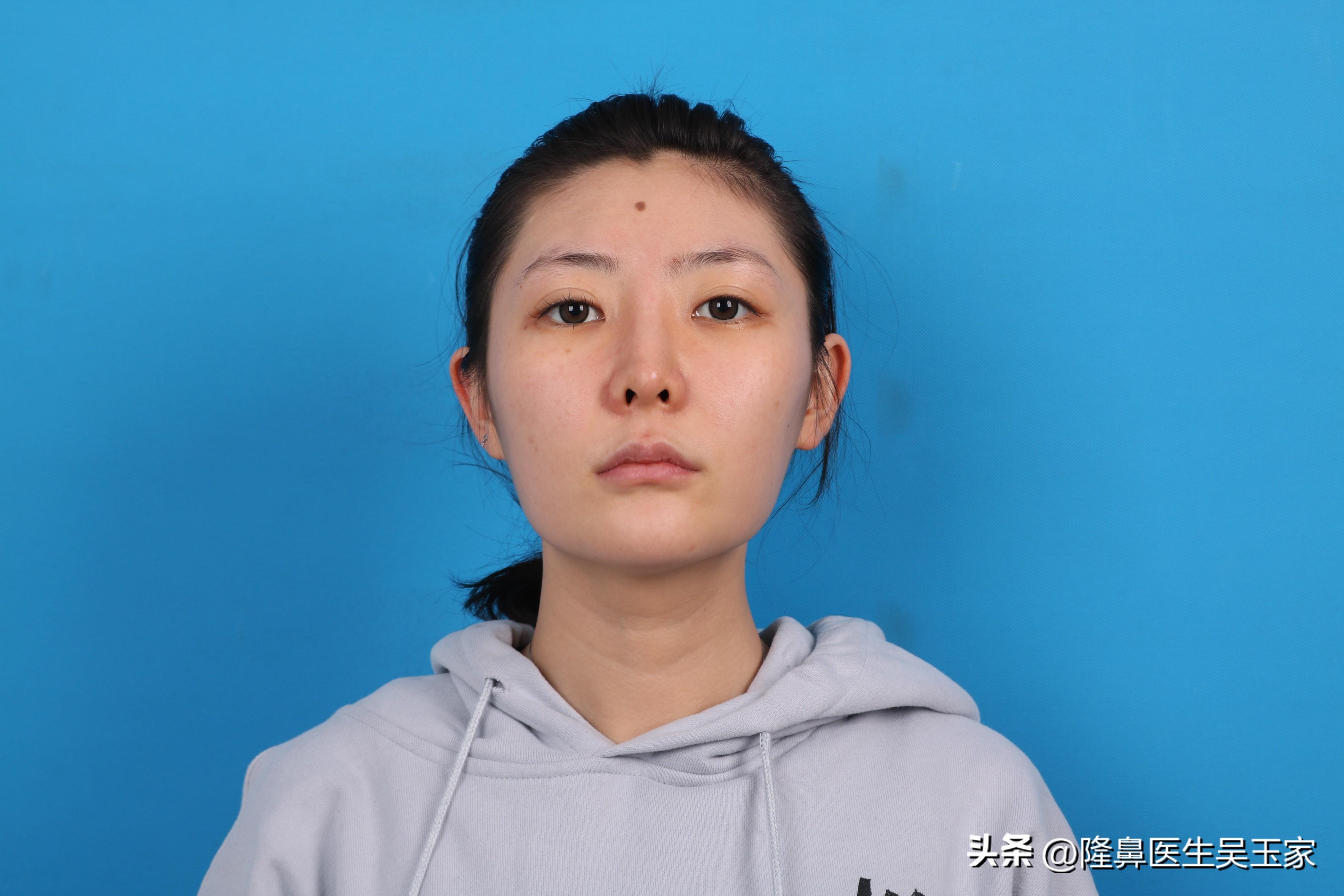28岁山东姑娘,独自来北京整容,2个月后反馈高清无美颜怼脸照_鼻梁