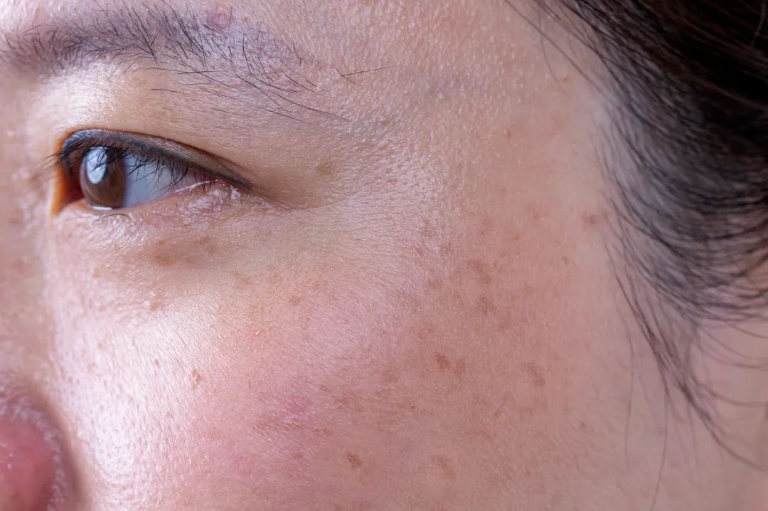 拿色斑为例,常见的是晒斑,医学上叫作日光性黑子,是皮肤对长期日晒的