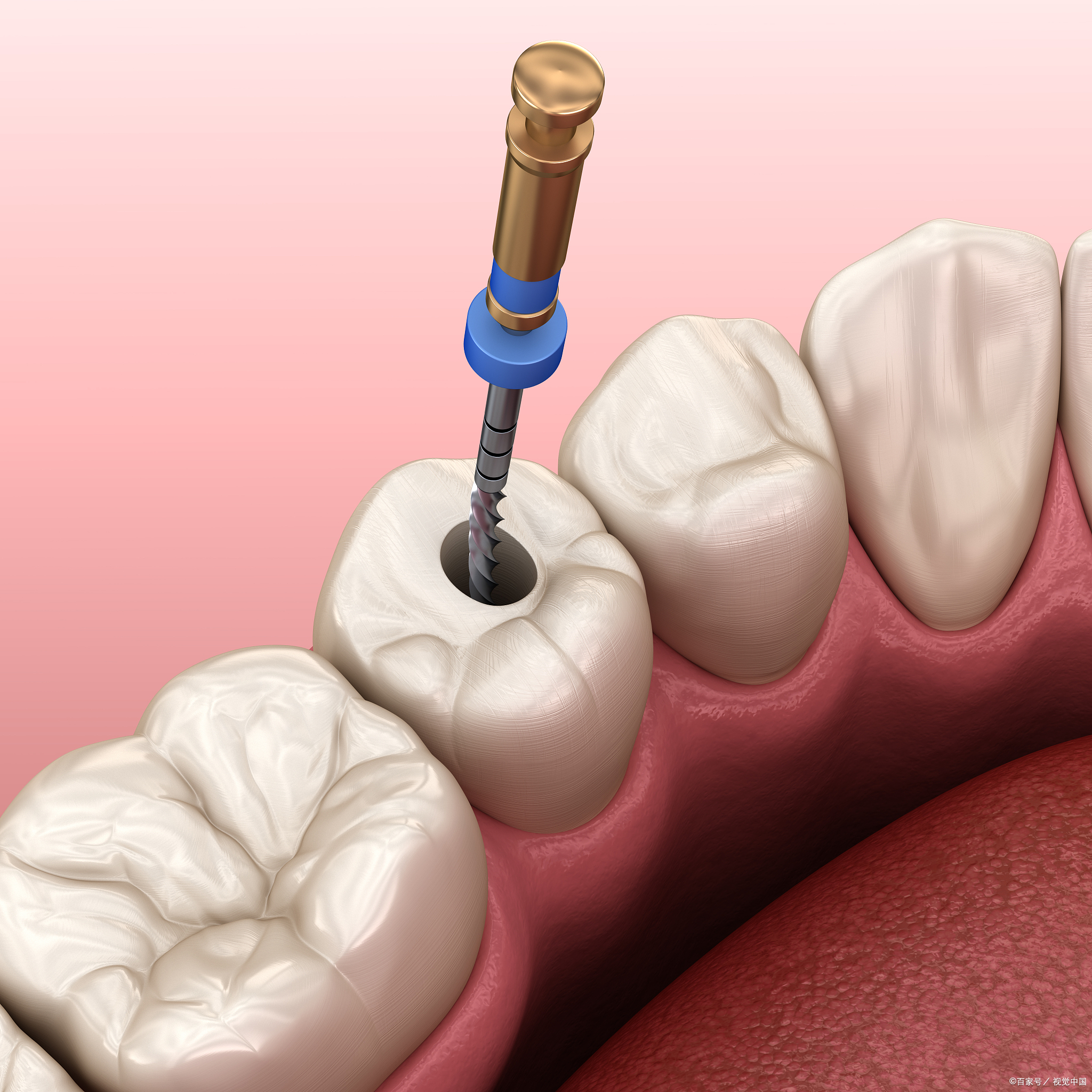 牙髓图片