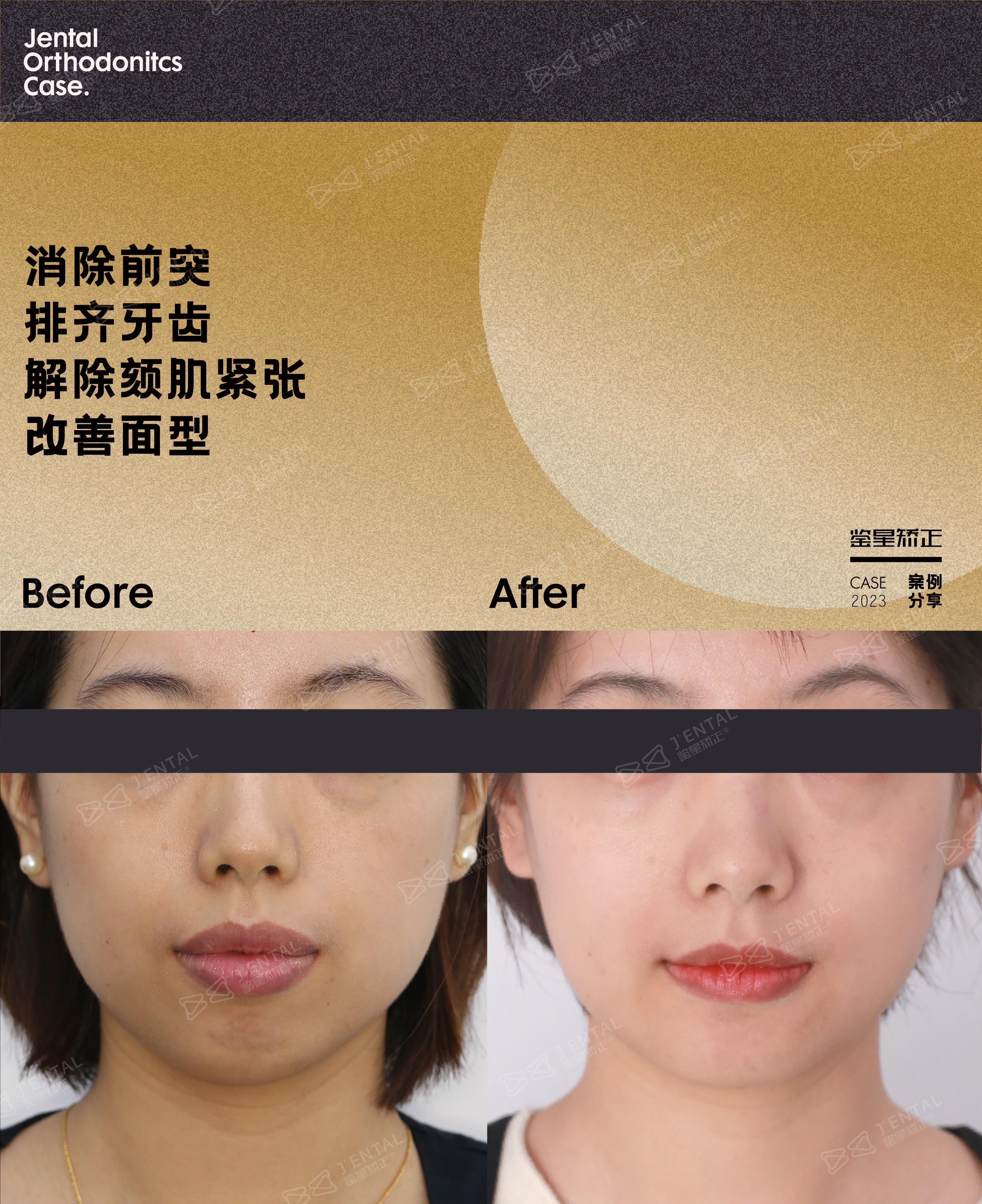 告别了骨感龅牙后不仅笑容柔和了下巴也露出来了?