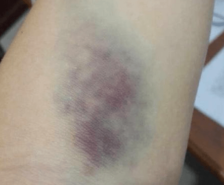 如果大家使用劣质的筋膜枪,在使用过程中容易出现击打力度不稳定,震频