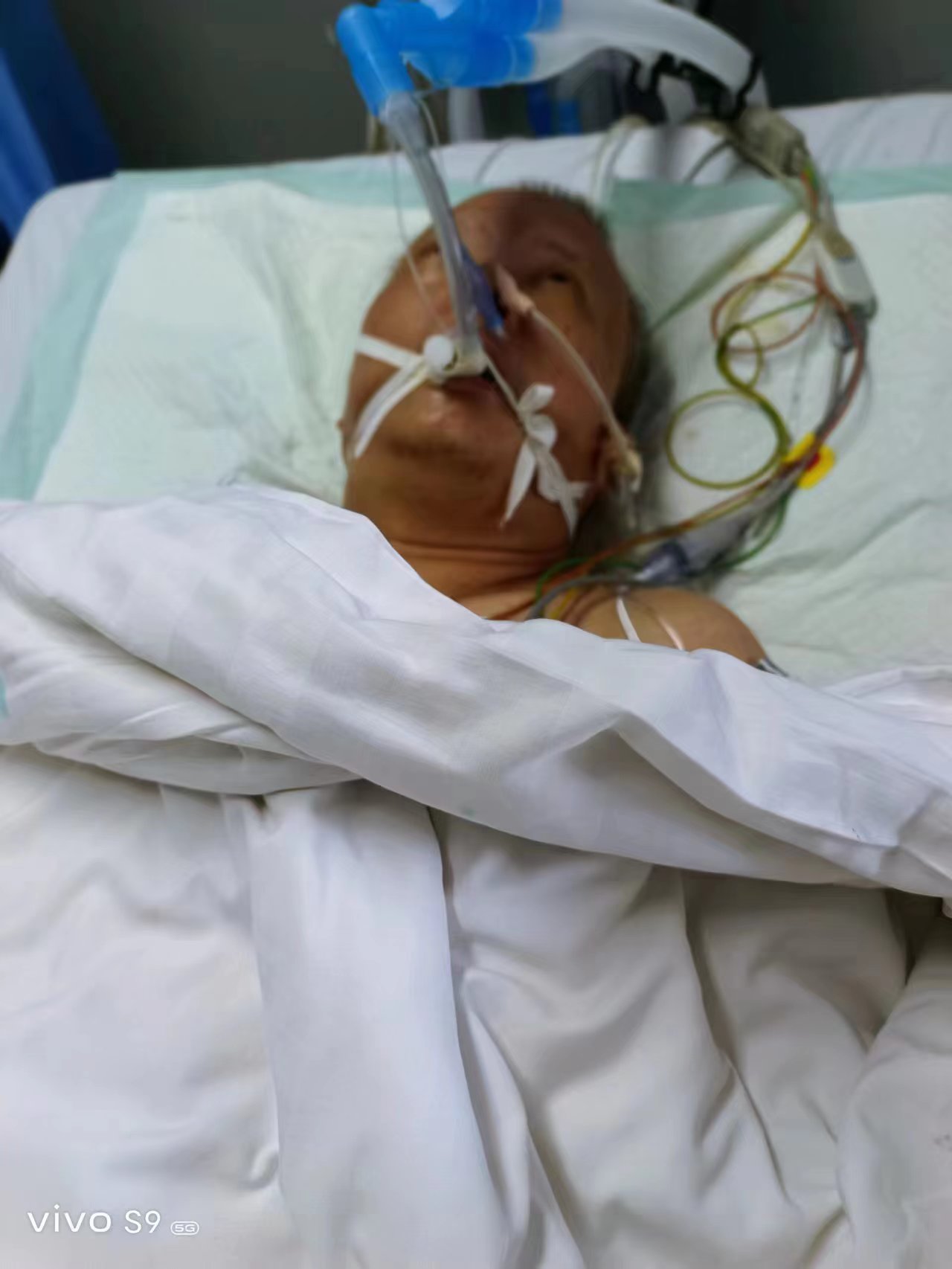 丈夫突然陷入昏迷,现因脓毒血症等在icu重点监护治疗,急需大家的帮助!