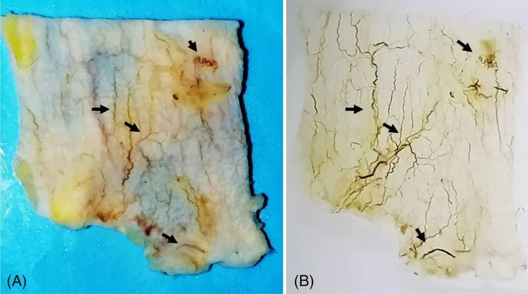 关于scarpa筋膜血管网络的临床研究_样本_染色_进行了