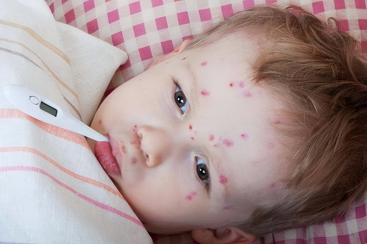 如何区分湿疹、荨麻疹和过敏(预防皮肤病的方法)