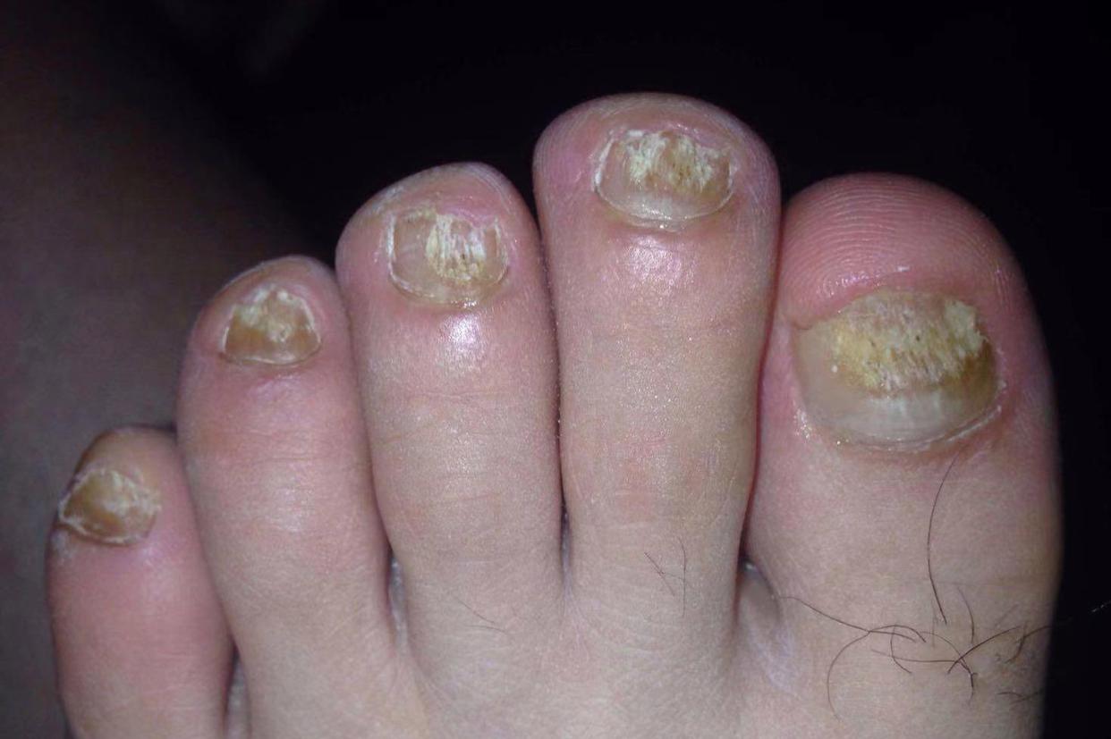 甲周还有死皮和白屑,最严重的几个指甲还出现了分层萎缩的情况!