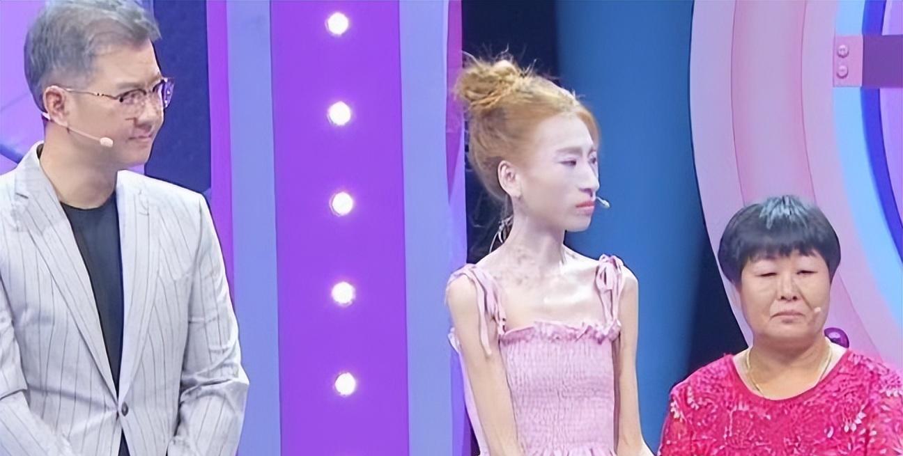 东北"骷髅妹"刘野,自虐式减肥,从120斤到58斤,直接吓跑男友_时小严