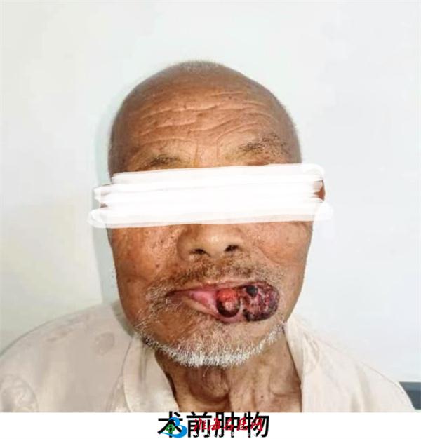 医院口腔颌面外科团队已顺利完成多例口腔颌面部恶性肿瘤的手术治疗