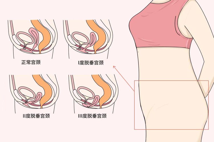 宫颈内口松弛图片图片