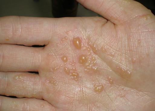 那是汗疱疹在作祟!三招教你解决!_皮肤_治疗_方法