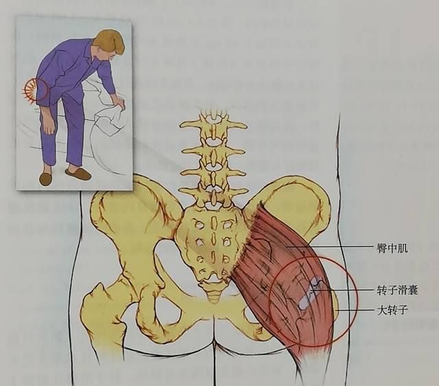 臀中肌疼是什么原因图片