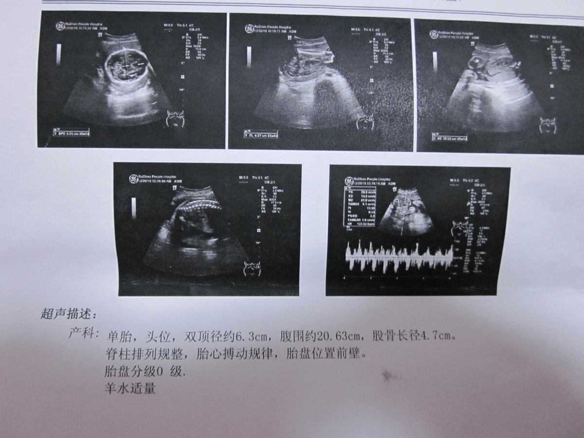 做b超宝宝不配合怎么办？孕妈指南：3个方法顺利查，40分钟回家站