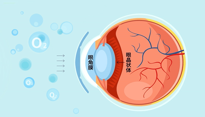 角膜塑形镜的矫正原理是利用高透气性的硬性隐形眼镜,轻柔地对角膜