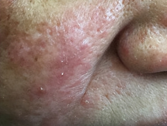 毛囊虫皮炎或蠕形螨病是怎么回事?_皮肤_治疗_面部