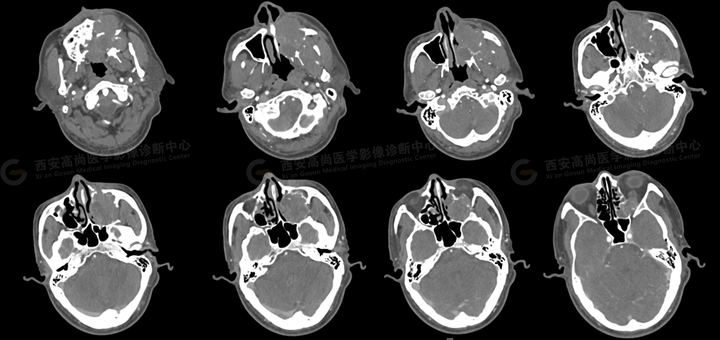 腺样囊性癌病例科普