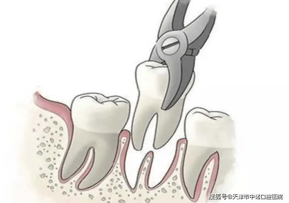 拔牙是不是可以瘦脸?所有智齿都要拔么?