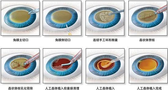 兰州爱尔眼科姚慧院长辟谣，激光手术后会更容易得白内障？真相并非如此 (图1)