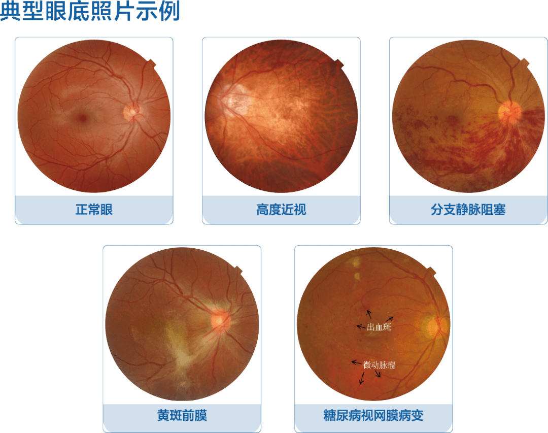 定期检查眼底,可以预防致盲眼病,你知道吗?_进行_病变_视网膜