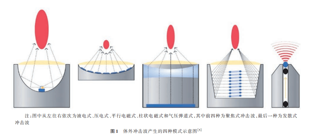 体外冲击波疗法临床应用中国疼痛学专家共识(2023版)!_治疗_能量_压力