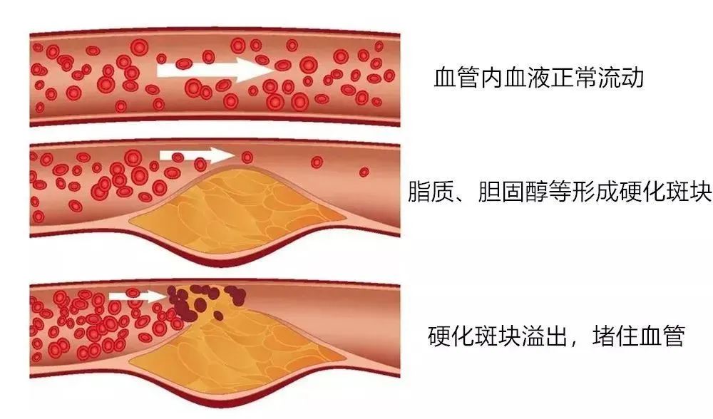 伴随纤维帽形成的纤维粥样硬化病变,由于在动脉内膜积聚的脂质外观呈