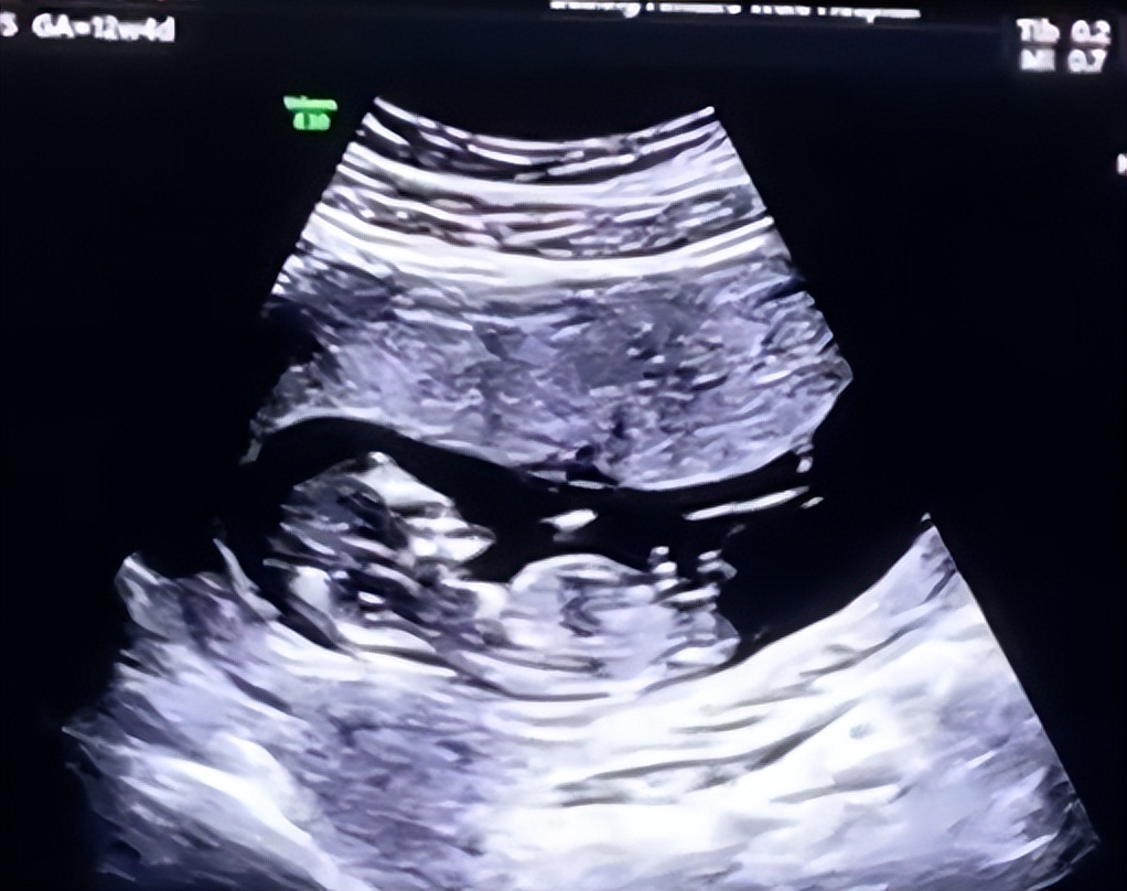孕10周宝宝b超图片图片
