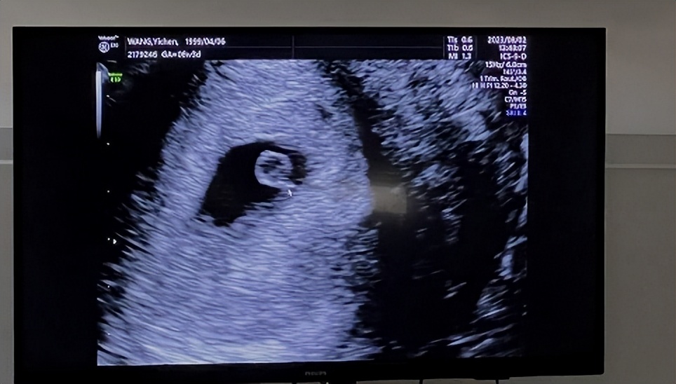 怀孕四个月b超男女图图片