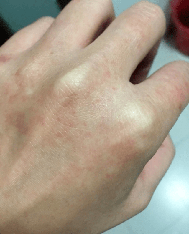 压根就没想过自己会得湿疹,一开始先是手背上长了几个小红点,有一丢丢