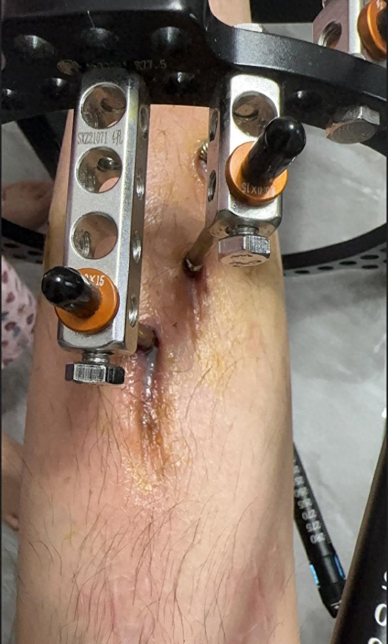 断骨增高,切断神经,腿细!你自己做的整容手术很疯狂,不是吗?