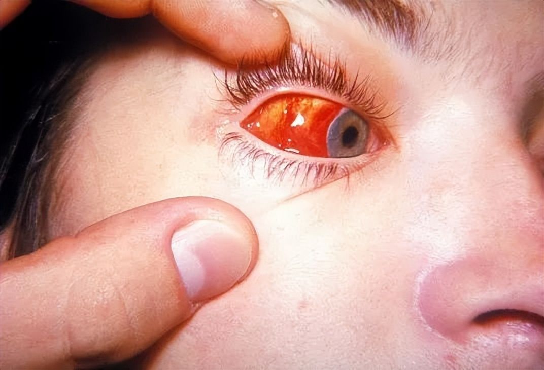 红眼病如何用对药