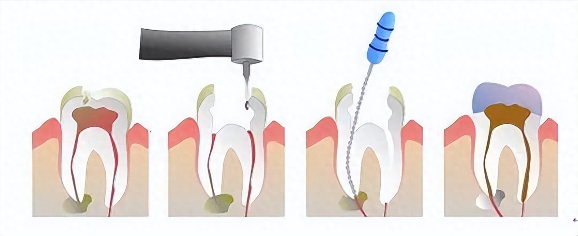 昆明口腔健康科普:根管治疗后的注意事项_牙齿_食物_小时