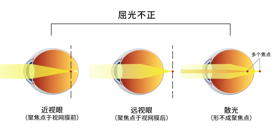导致光线聚焦在视网膜前面,看远处模糊;远视是指眼球轴长过短或者角膜