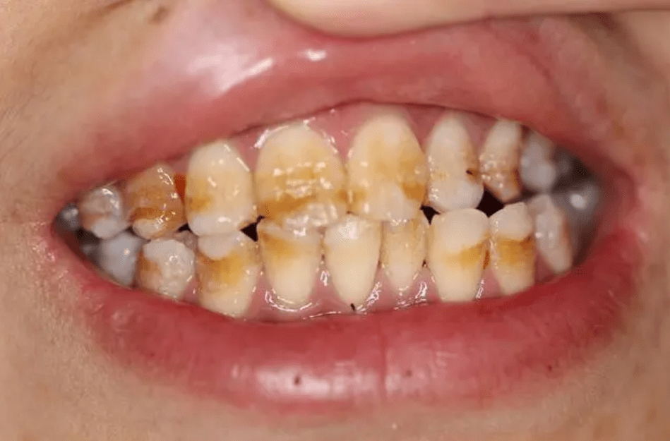 满嘴黄渍咖啡渍怎么去除?过来人教你几招,在家也能刷出大白牙!