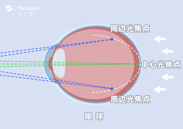 离焦框架眼镜和OK镜,区别是什么?应该怎么选?_防控_周边_孩子