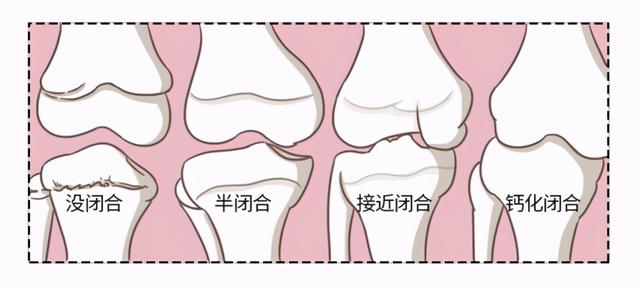 身高也会停止增长直至成年,骨骺完全闭合后长骨的生长速度会减慢到了