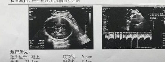 b超单上的这3个数据,或许暗示你"小王子"在腹中