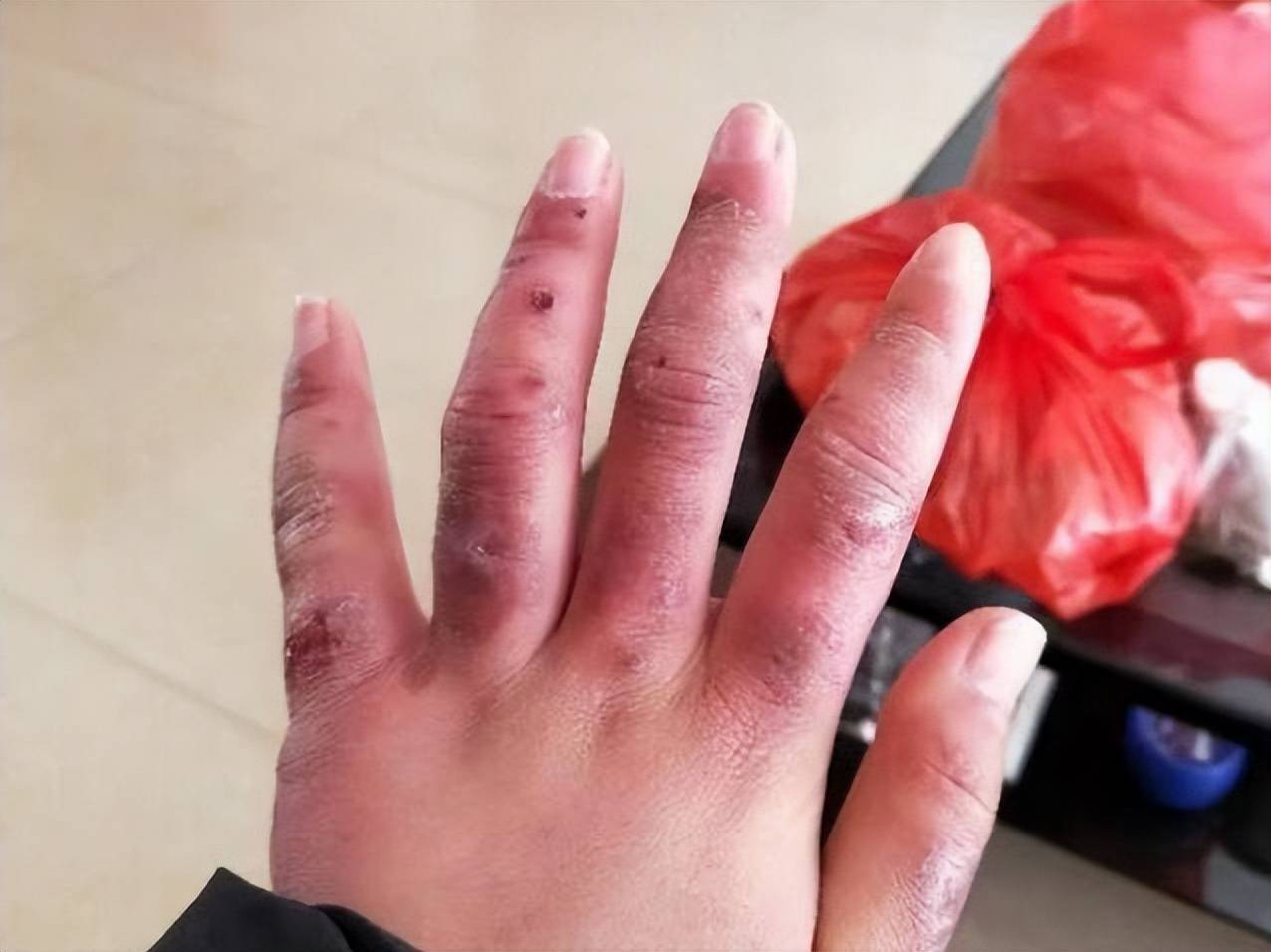 冻疮反反复复不见好!这份过来人自救攻略,7天快速消肿止痒!_方法_艾灸