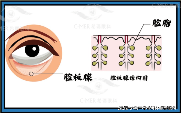 眼睑里面有一种腺体叫睑板腺