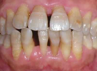 长期牙齿松动是什么原因引起的?_问题_口腔_牙龈