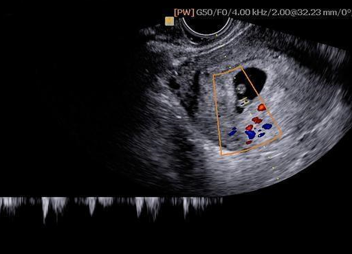 怀孕男宝宝b超图片2月图片