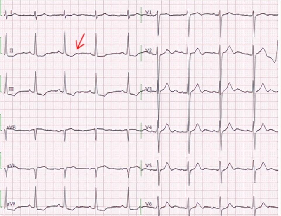 窦性心律2ii,iii,avf导联st