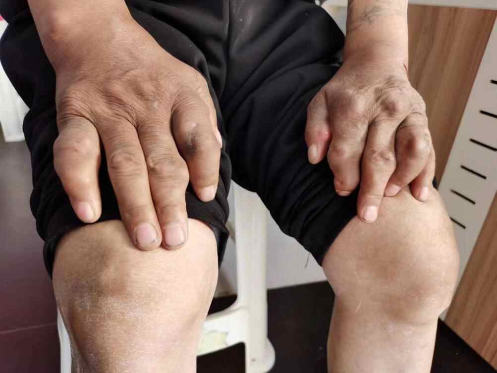 上海在线网专题报道云南一中医独创"风湿骨病新诊疗法"_杨医生_治疗