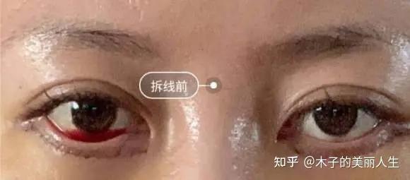 解答疑问:眼袋手术有风险和后遗症吗,深扒做眼袋手