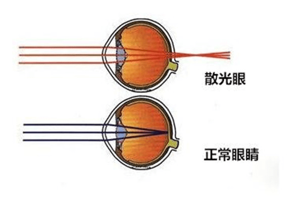 角膜子午线图片