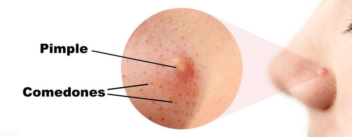 轻度(Ⅰ级)痘痘主要表现为黑头,白头,没有脓包和结节