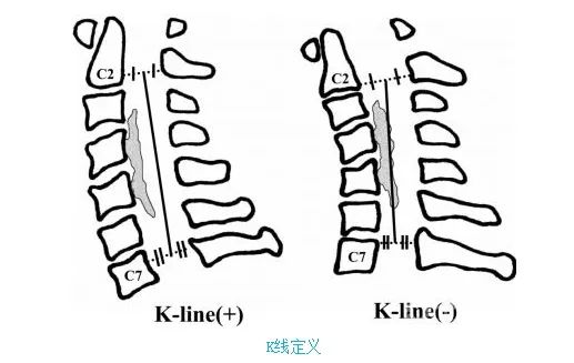 "k"代表后凸(kyphosis),k线是指在颈椎x线侧位片上,通过c2和c7椎管