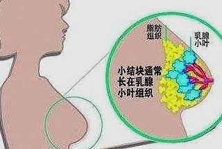 乳腺結節可不可以不做手術呢?怎樣治療乳腺結節呢?_檢查_處理_患者