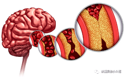 脑梗会不会引起四肢疼痛吗?_障碍_症状_其他
