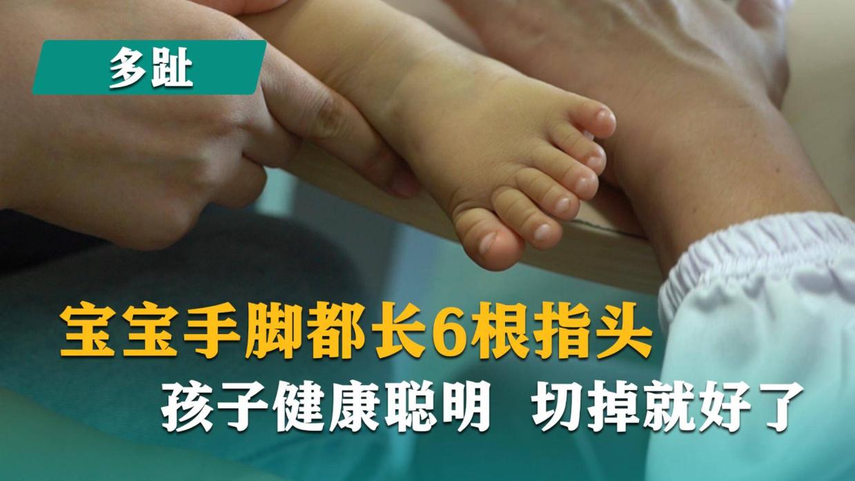 宝宝手脚都长6根指头,孩子健康聪明,切掉就好了