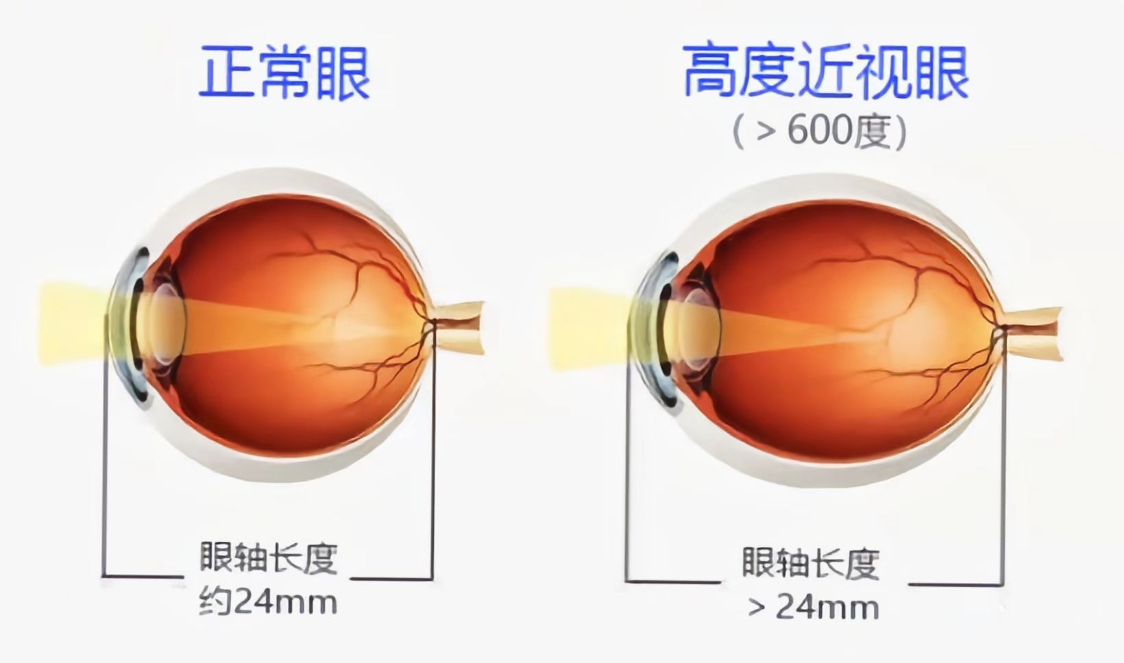 近视眼与正常眼睛外观图片