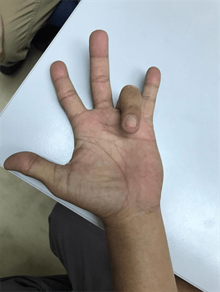 医生解答:听说过"扳机指"么?_治疗_疾病_活动